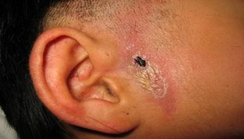 瘘管开口多位于耳轮脚前,少数可在耳廓之三角窝或耳甲腔部.