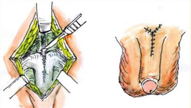 阴茎延长手术过程