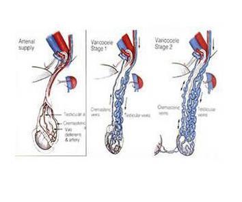 睾丸静脉曲张