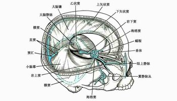 sinus and superior petrosal sinus,即乙状窦,横窦及岩上窦汇合处
