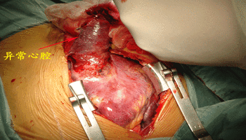 (图)后天性心脏病的手术
