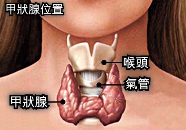 甲狀腺結節鈣化